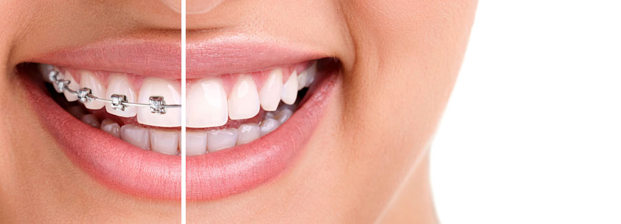 Invisalign Clear Braces, Ottawa Dentist