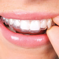 Invisalign Clear Braces, Ottawa Dentist